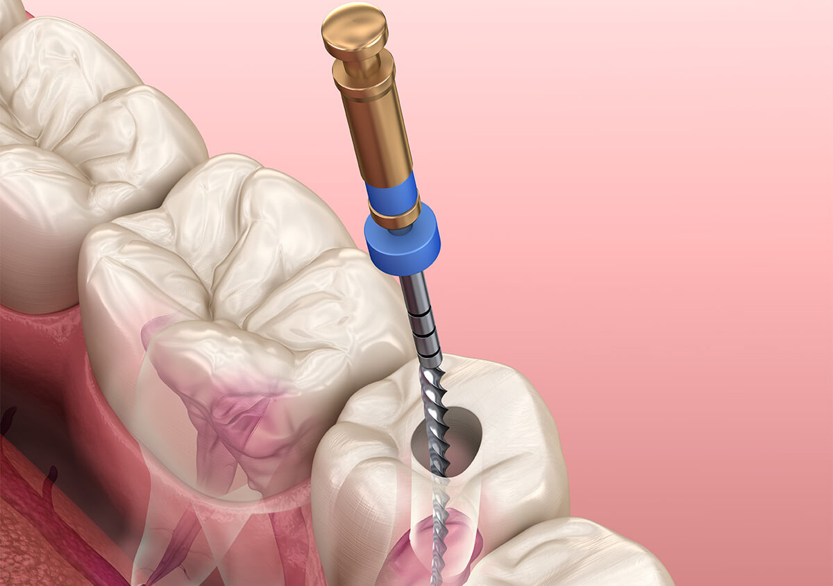 Signs You Need a Root Canal in Granite Bay CA Area