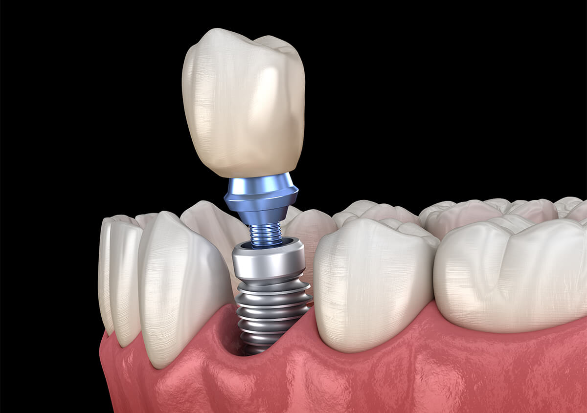Permanent Dental Implants in Granite Bay CA Area